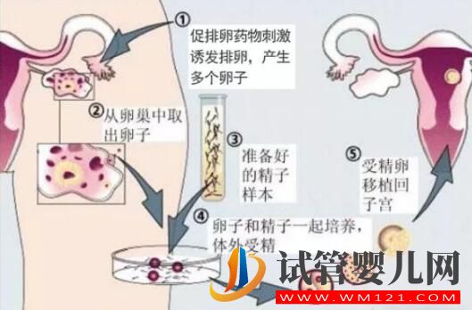 人工授精多次失败后还可以做试管婴儿吗?(图2)