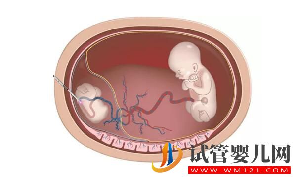 试管婴儿减胎术在哪些情况下使用 要注意哪些(图1)