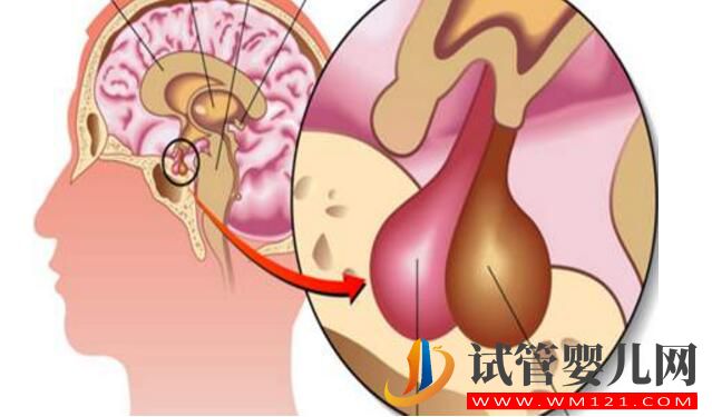 泌乳素高会影响做试管婴儿吗？如何比较好？(图1)