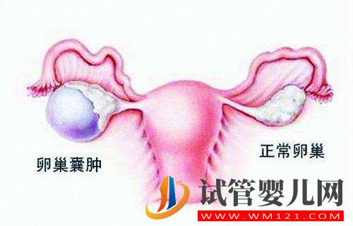 左侧卵巢被割除、三次试管失败她该怎么办？(图1)
