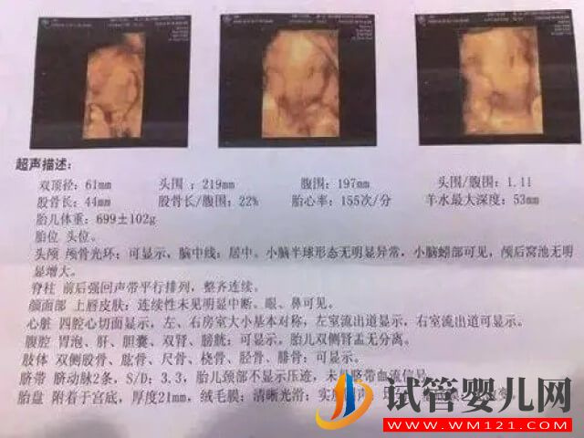 B超单上一个孕囊双胞胎的迹象有哪些？(图1)