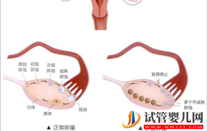 多优势卵泡形成原因解析，滥用促排药占很大部分(图1)