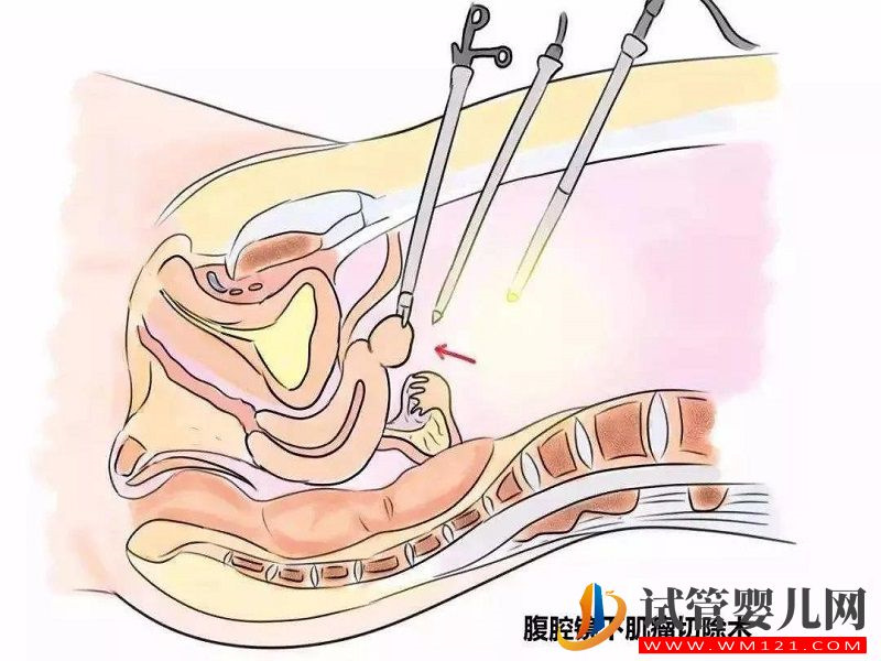 子宫肌瘤4cm切除与否需谨慎，试管助孕能否成功由它决定(图2)