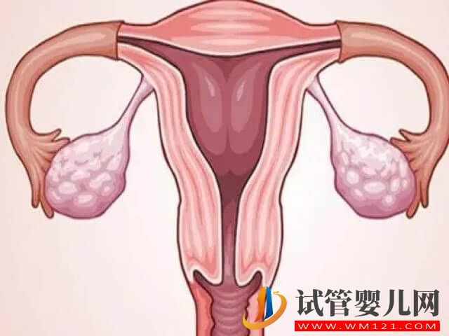 子宫疤痕憩室做试管婴儿能一次就成功吗？(图1)