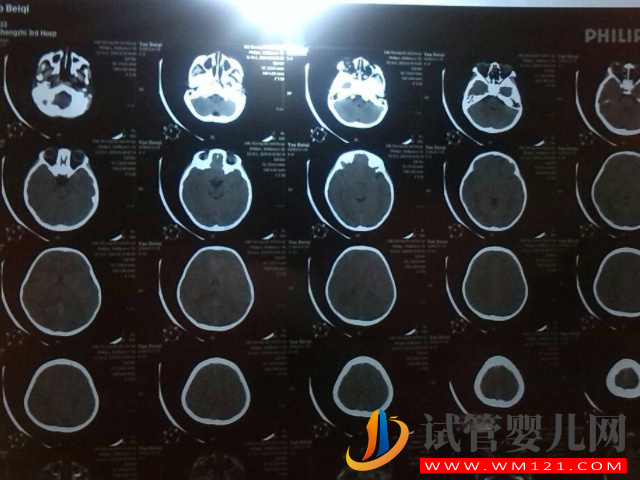 宝宝摔了千万不要做脑部ct的原因汇总，过来人都直呼后悔！(图1)