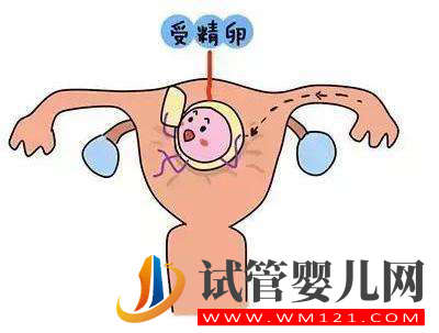 试管婴儿胚胎移植后腹部两侧疼是不是宫外孕？(图1)