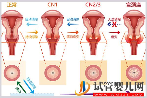 宫颈低度病变lsil可以做试管，但可能影响胚胎着床成功率(图2)