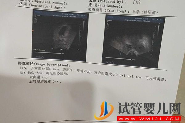 试管移植28天胎心胎芽标准来了，看不见1周后需超声复查(图2)