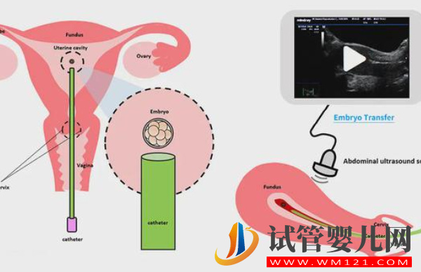 试管人工移植冻胚周期是什么流程，具体步骤有4个(图1)