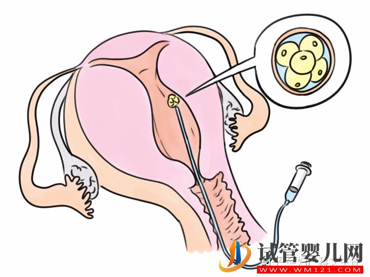 试管适应症_第一代试管婴儿(图1)