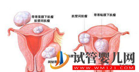 输卵管通液和输卵管造影有什么区别(图1)