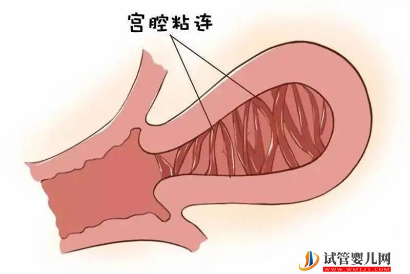 宫腔粘连严重，试管3次不成功原因分析(图1)