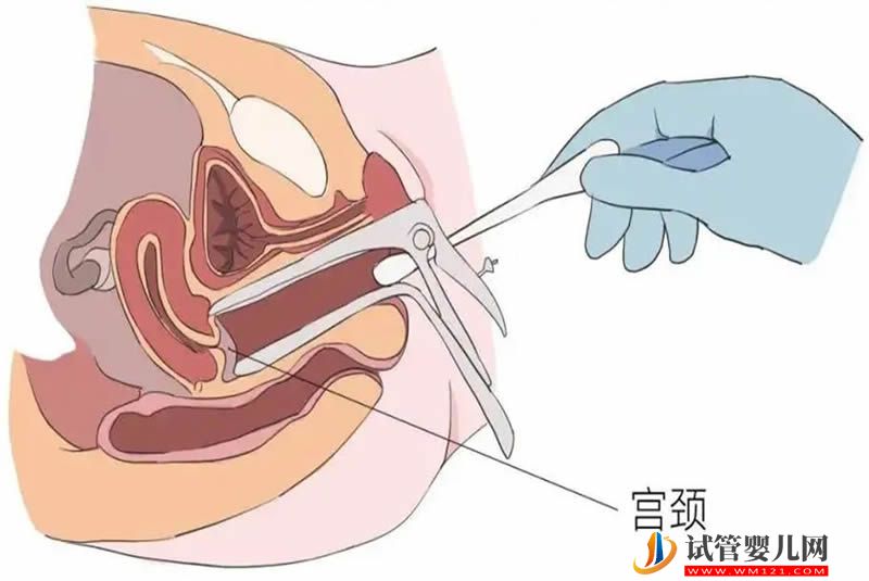 宫腔粘连严重，试管3次不成功原因分析(图2)