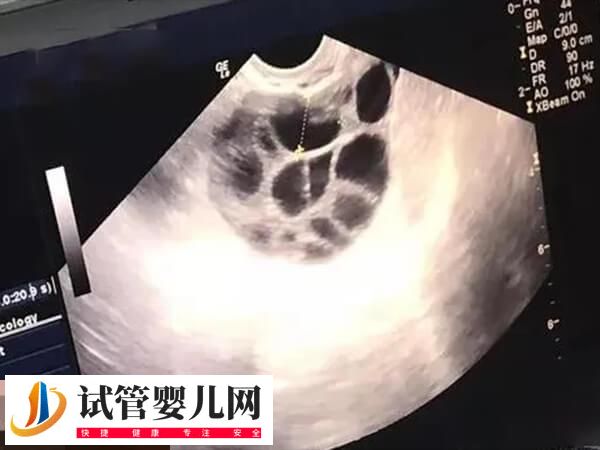 取卵18个能配多少胚胎看情况，有的配3-5个也算正常(图2)